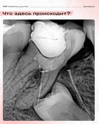 Апекслокация: точный путь к успешному лечению.